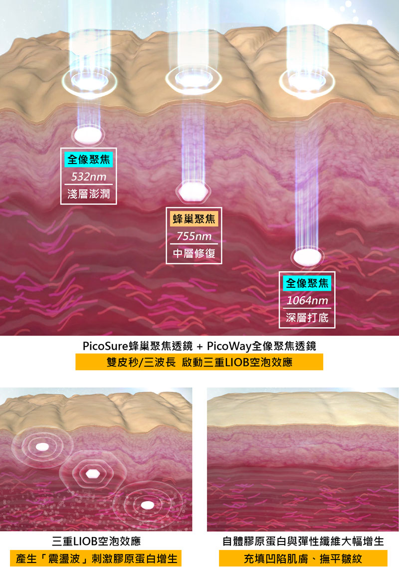 除痘疤的關鍵在於聚焦透鏡技術